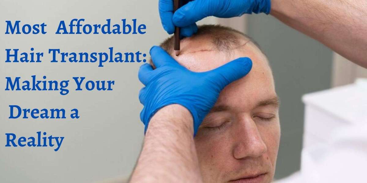 Most Affordable Hair Transplant: Making Your Dream a Reality
